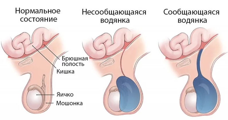 Водянка яичка (гидроцеле) - причины, симптомы, диагностика, лечение (операция)